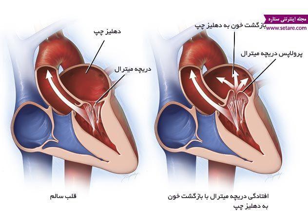 علت و علائم افتادگی دریچه میترال چیست؟