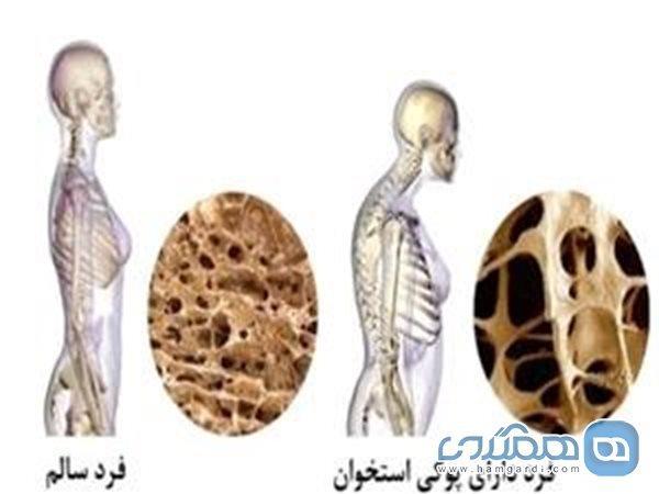 چگونه لاغر شدن ما را به پوکی استخوان مبتلا می نماید؟